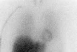 MIBG scanning in the heart