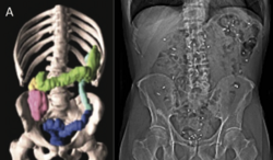 CT scan of the abdomen